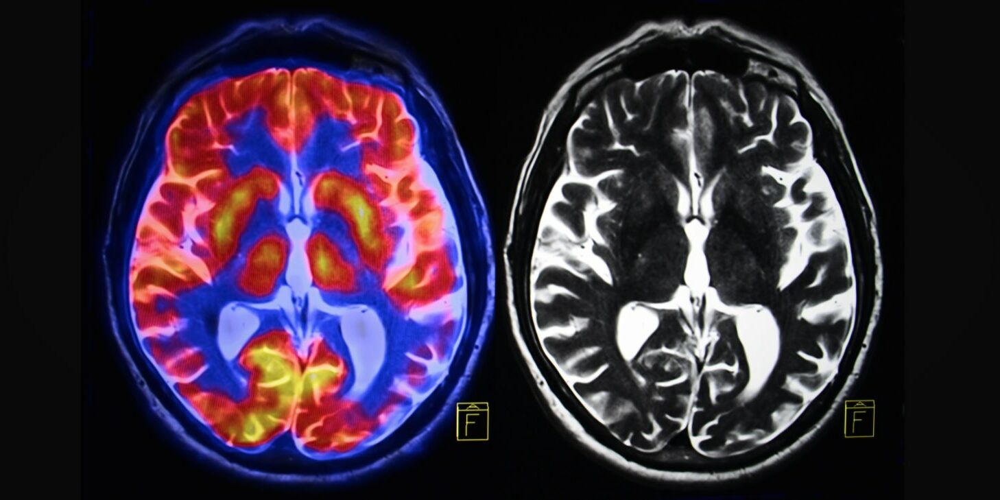 cerveau-addiction-porno-guérison Guérir le cerveau de l'addiction au porno est possible